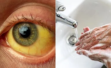 Na východe evidujú hygienici tri ohniská žltačky, šíri sa medzi deťmi aj dospelými. Obce prijali opatrenia