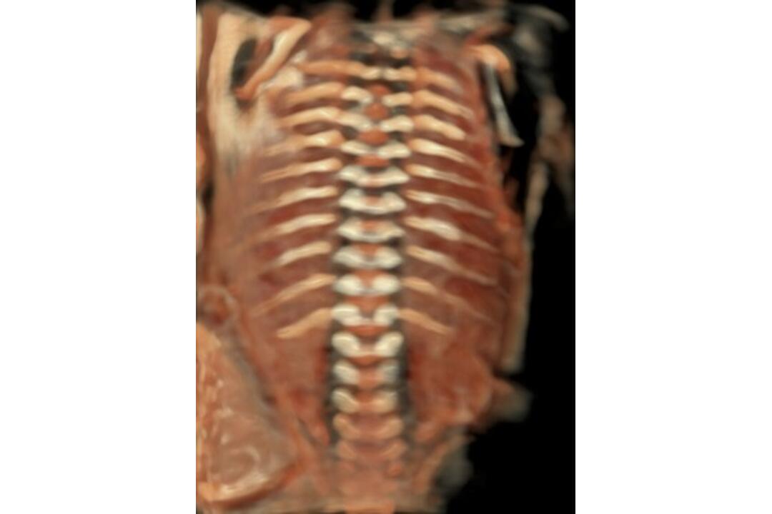 FOTO: Šačianska nemocnica predstavila najmodernejší ultrazvuk, foto 4