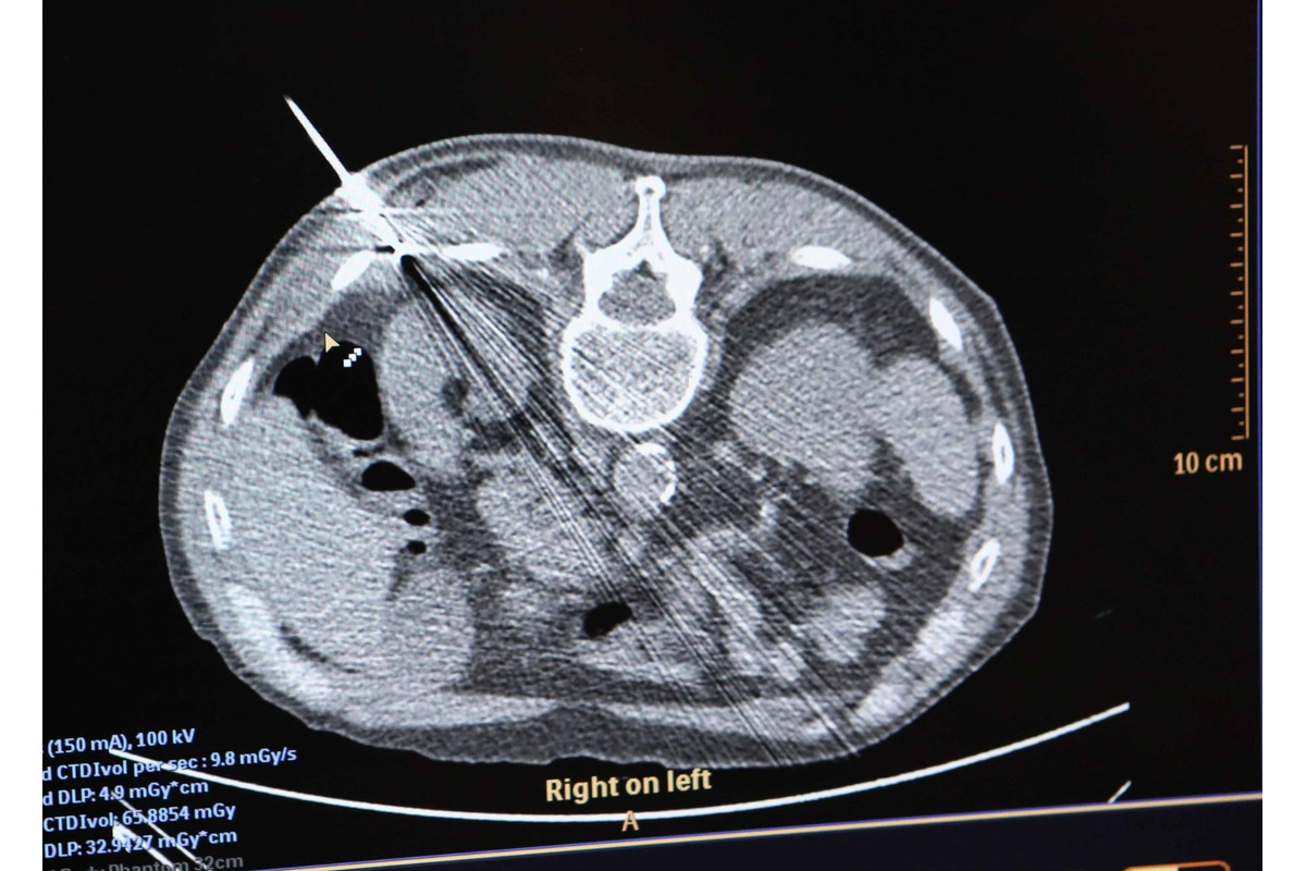 FOTO: Košická univerzitná nemocnica zaviedla pokrokovú liečbu tumorov, foto 3