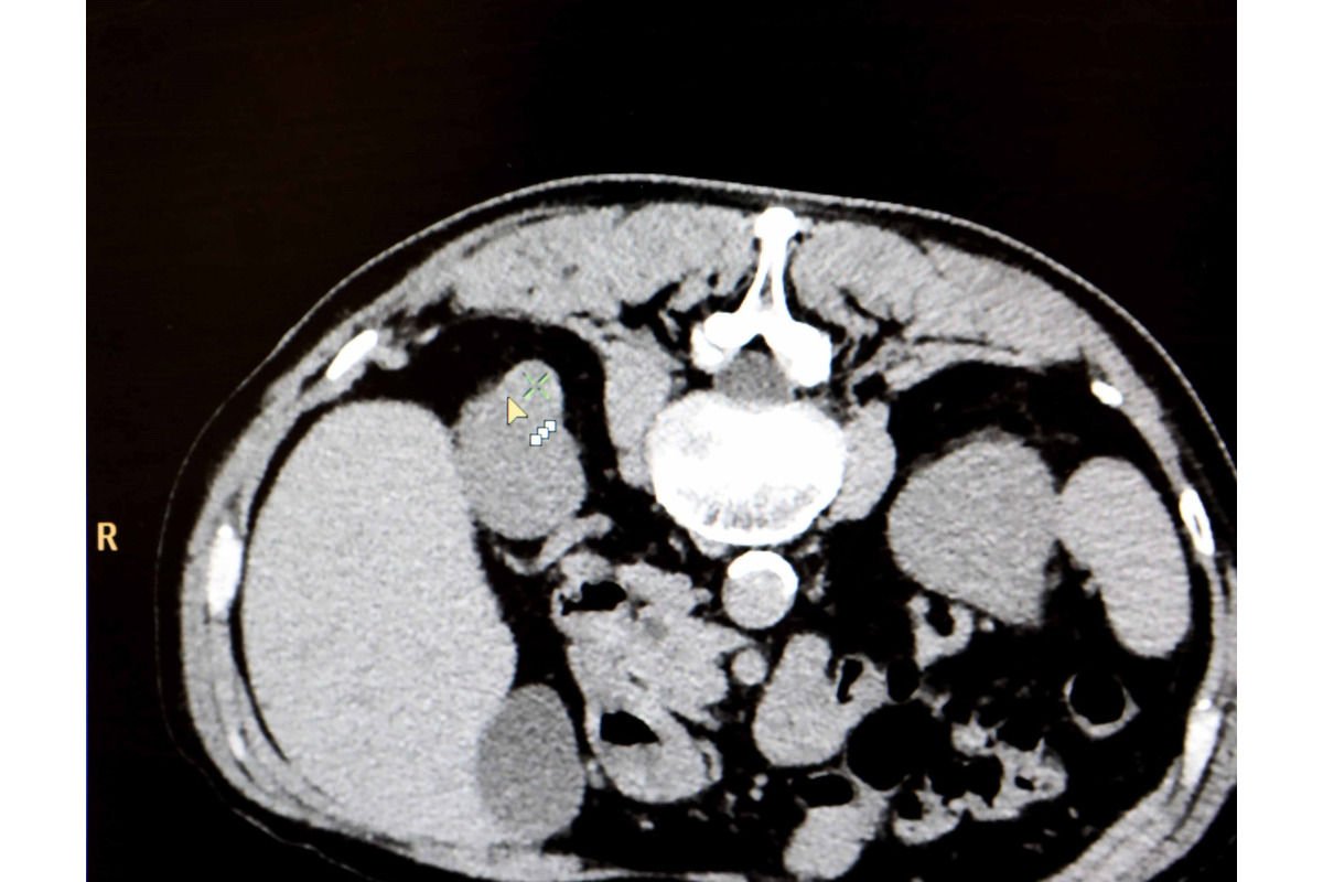 FOTO: Košická univerzitná nemocnica zaviedla pokrokovú liečbu tumorov, foto 5