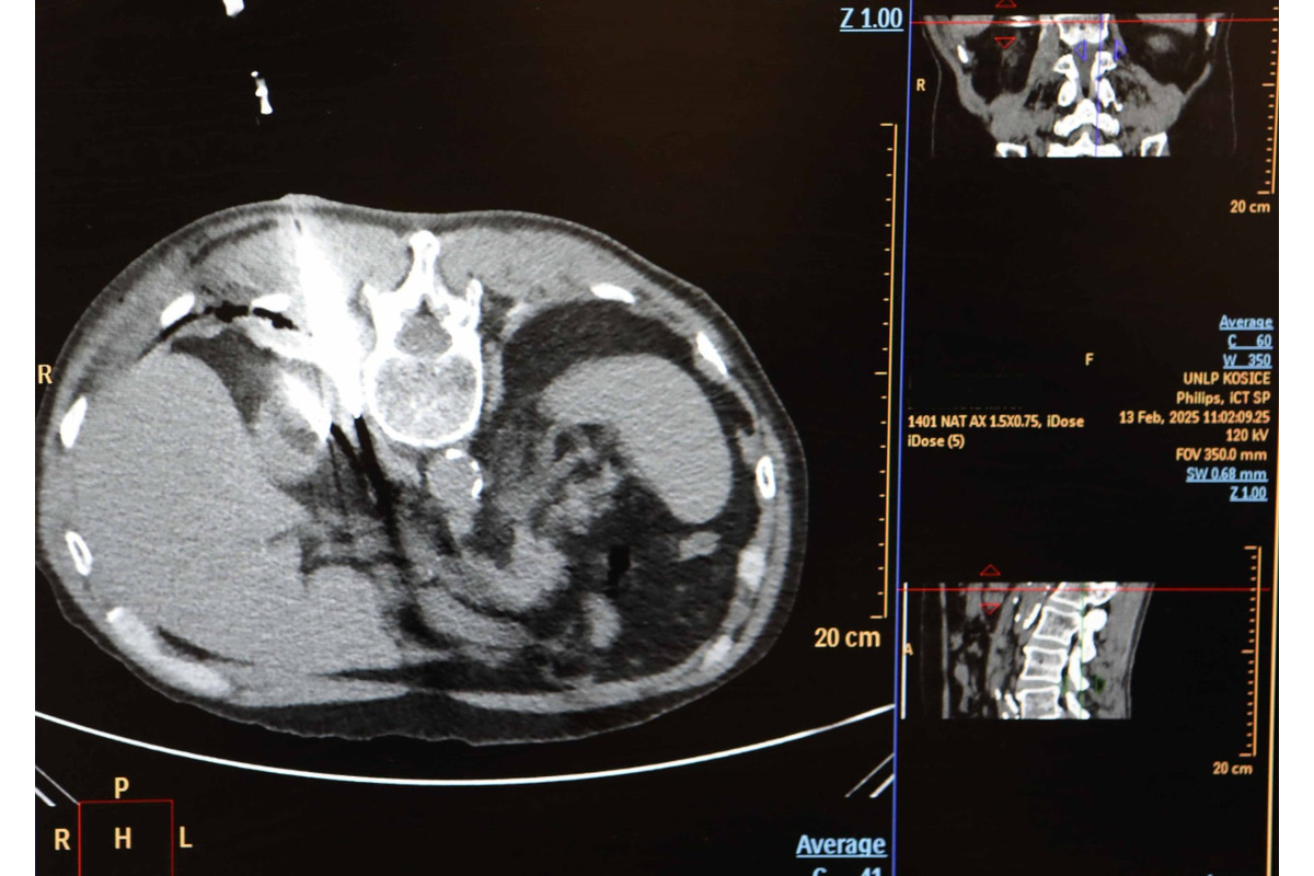 FOTO: Košická univerzitná nemocnica zaviedla pokrokovú liečbu tumorov, foto 8