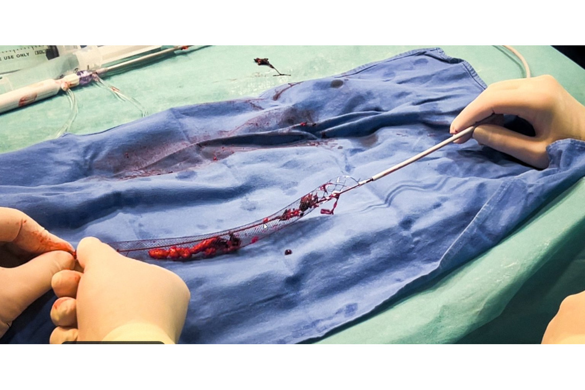 FOTO: Nová metóda liečby žilovej trombózy vo VÚSCH, foto 3