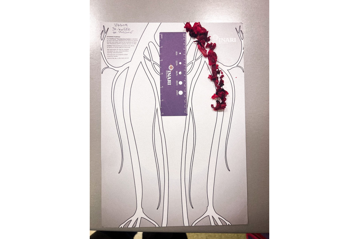 FOTO: Nová metóda liečby žilovej trombózy vo VÚSCH, foto 4