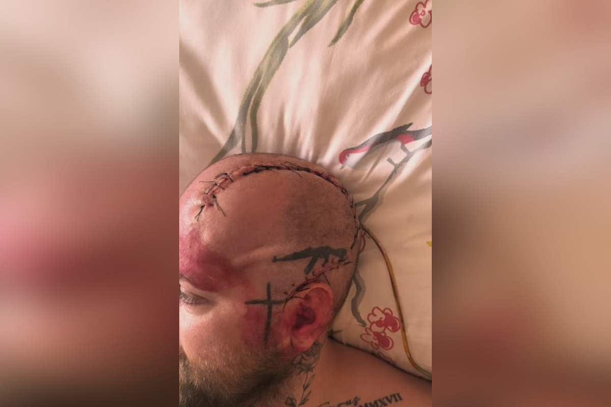 FOTO: Zápasníka MMA operovali na Kramároch, foto 1