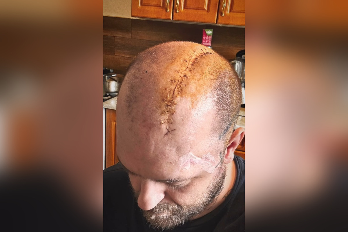 FOTO: Zápasníka MMA operovali na Kramároch, foto 4