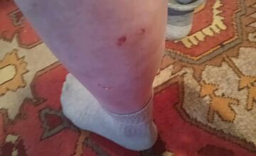 FOTO: Na seniora z Rožňavy zaútočil pes