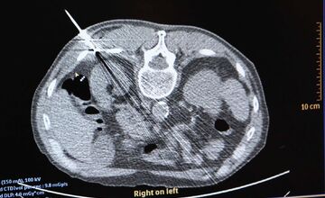 FOTO: Košická univerzitná nemocnica zaviedla pokrokovú liečbu tumorov