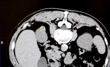 FOTO: Košická univerzitná nemocnica zaviedla pokrokovú liečbu tumorov