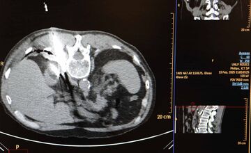 FOTO: Košická univerzitná nemocnica zaviedla pokrokovú liečbu tumorov