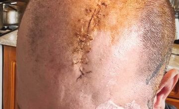 FOTO: Zápasníka MMA operovali na Kramároch